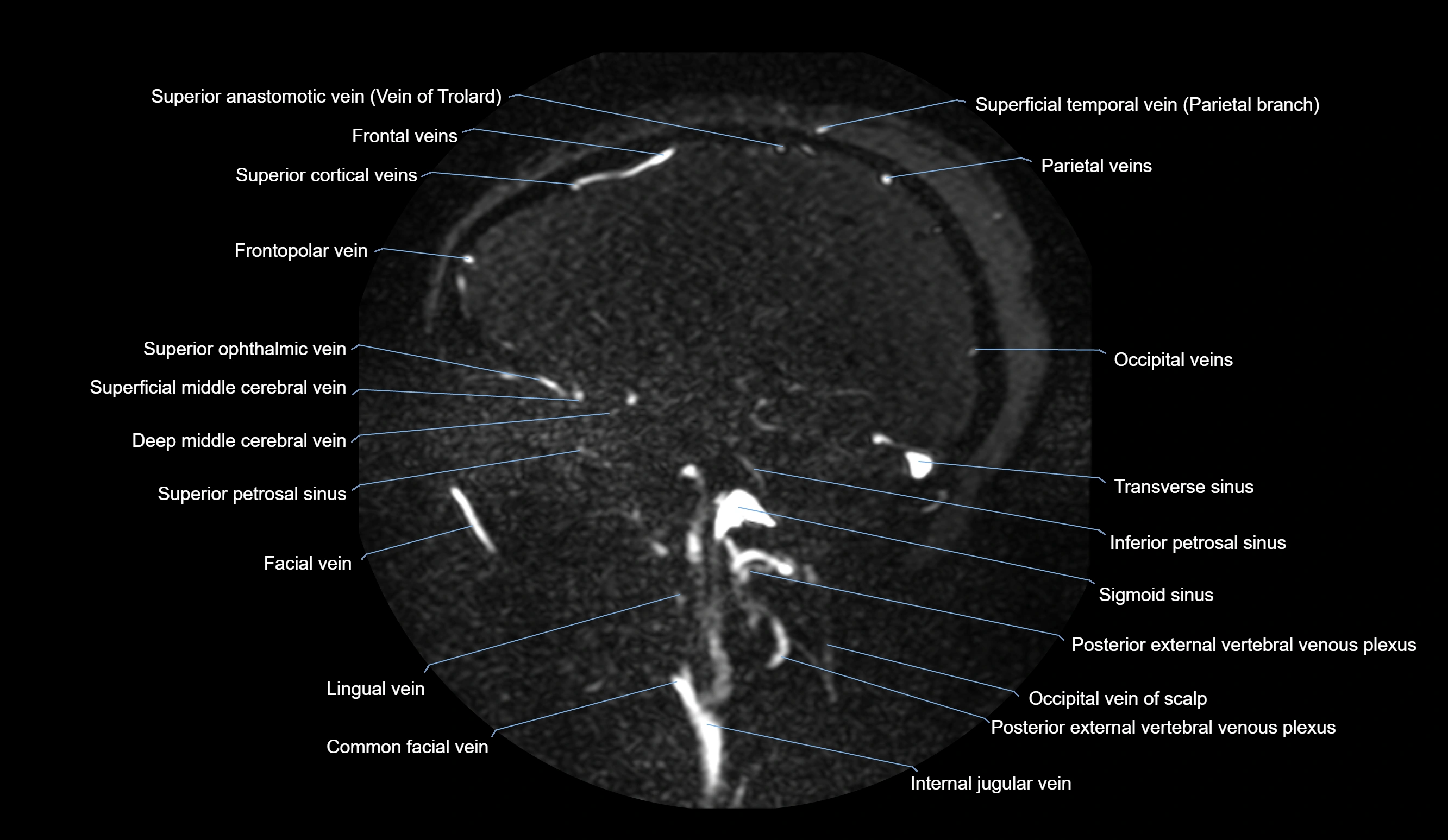 MRV brain sagittal anatomy 3T MRI labelledimages -00029.webp